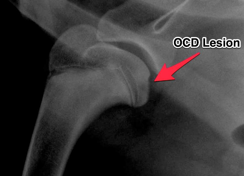 osteochondritis dissecans