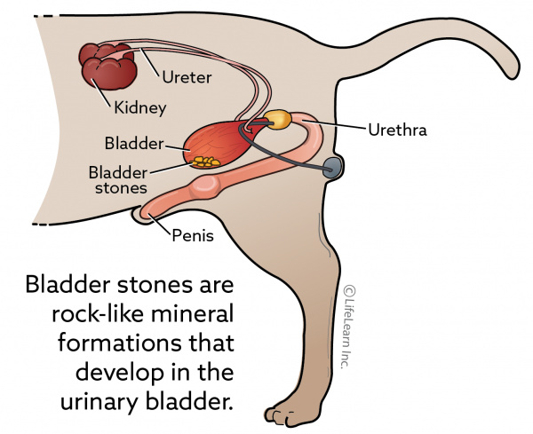 bladder stones