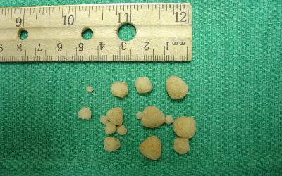 bladder stones