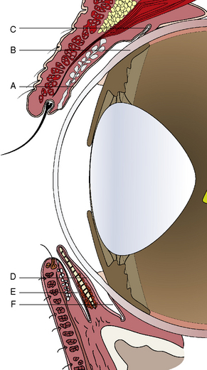 Conjunctival Graft for Rupture Globe