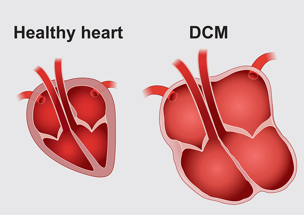 Dilated Cardiomyopathy