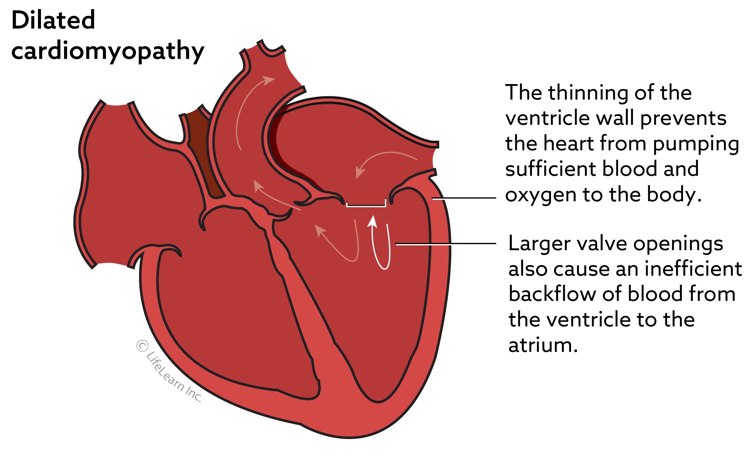 Dilated Cardiomyopathy