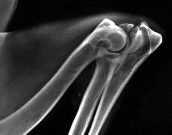 Elbow Dysplasia