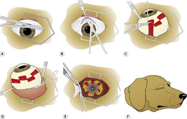 Enucleation for Rupture Globe