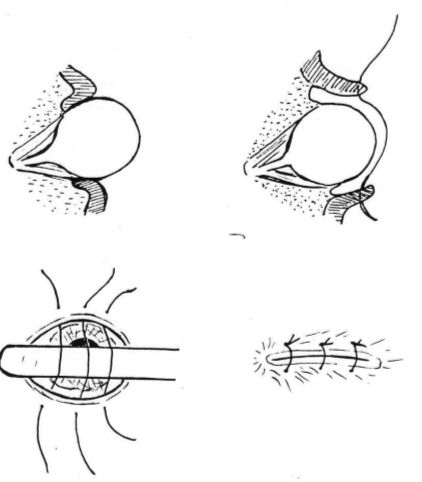 Enucleation for Rupture Globe