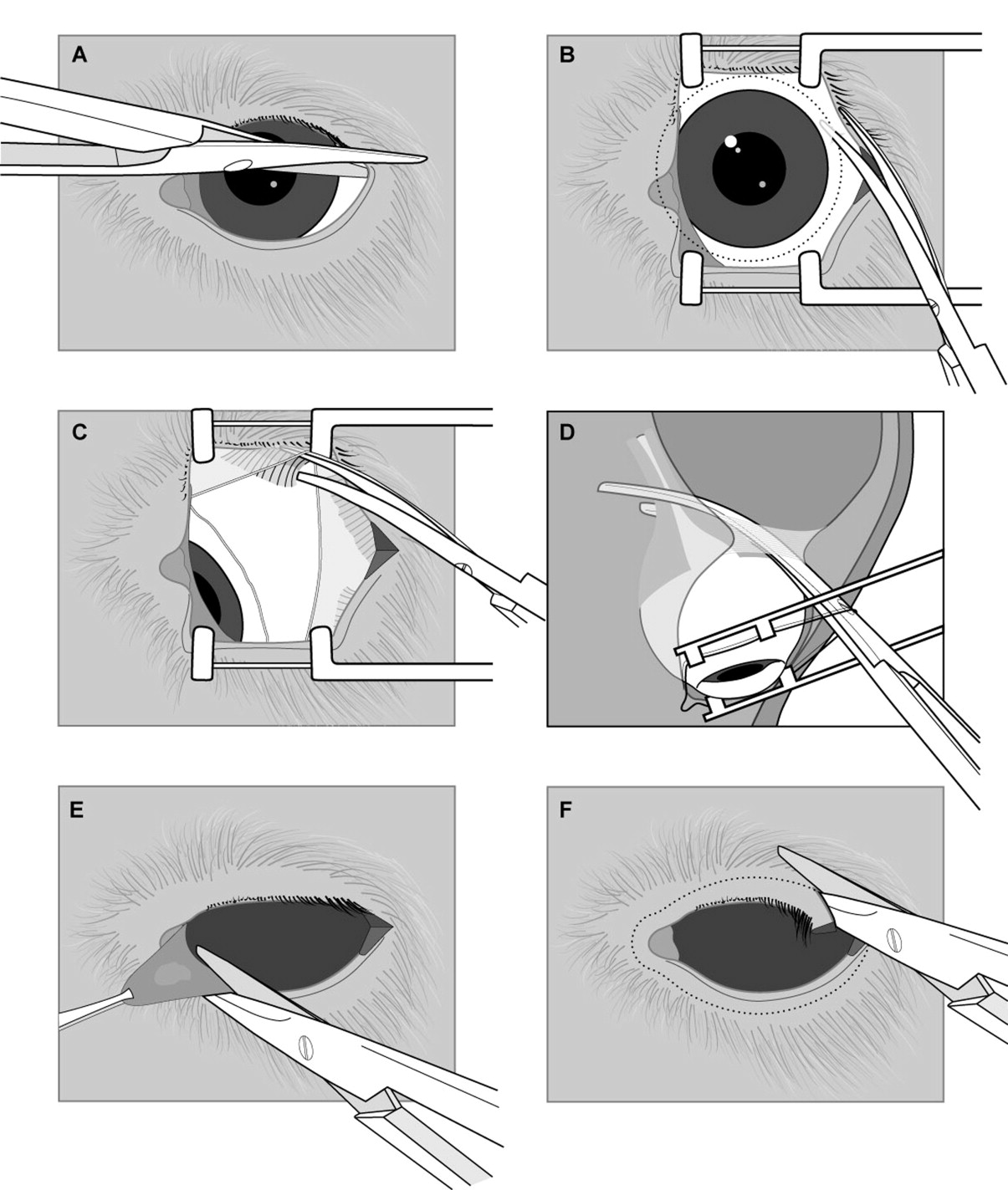 Enucleation for Rupture Globe