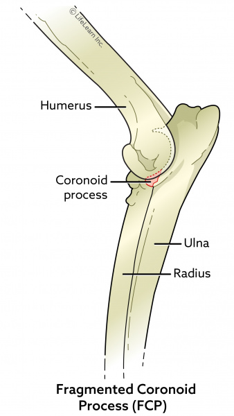 Fragmented Coronoid Process