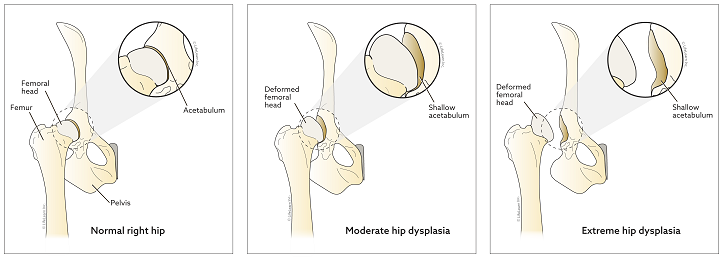 Hip Dysplasia