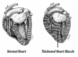 Hypertrophic