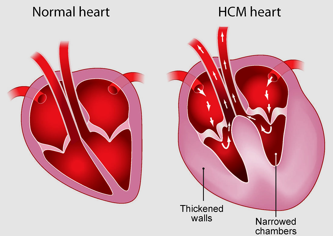 Hypertrophic