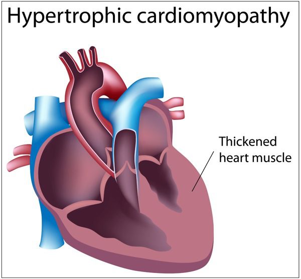 Hypertrophic