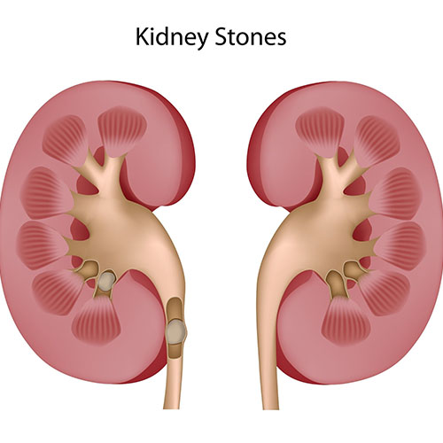 Kidney Stones in Cats