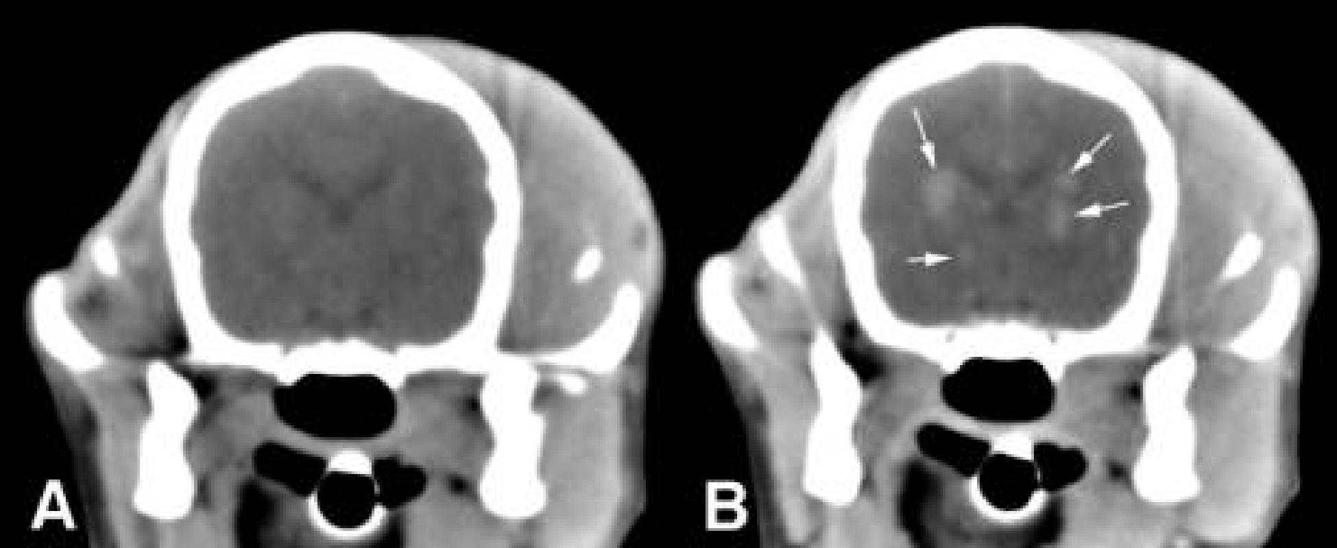 Meningitis