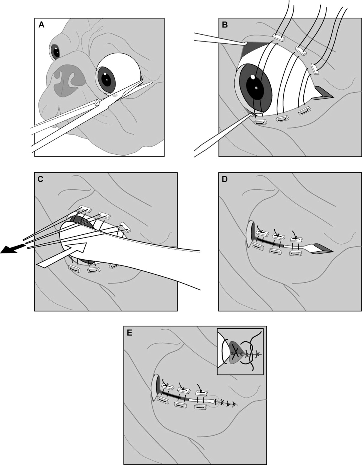 Nuclear Proptosis Surgery