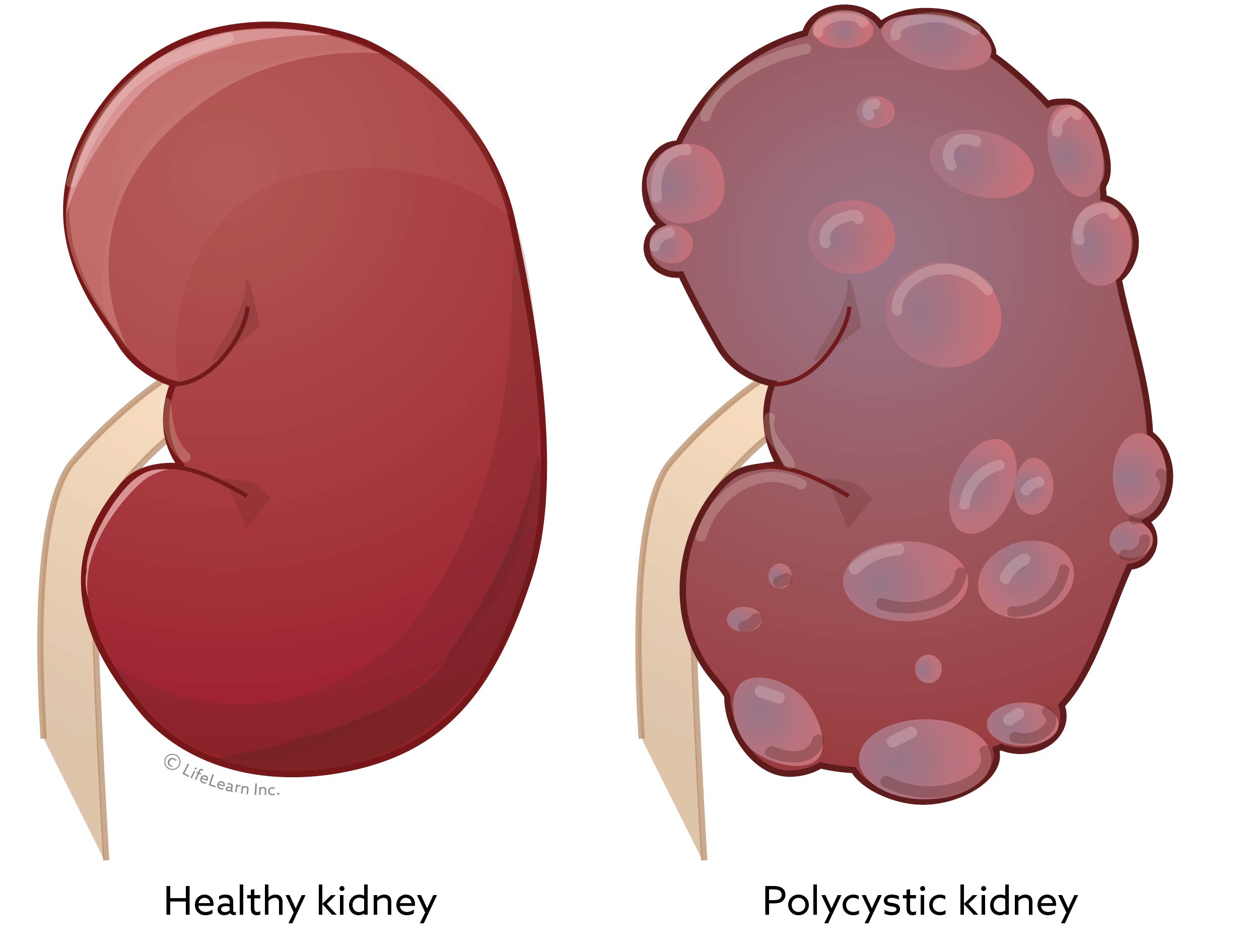 Polycystic Kidney Disease (PKD)