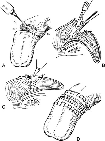 Tongue Laceration Repair