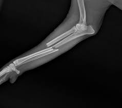 Traumatic Bone Injury & Fracture