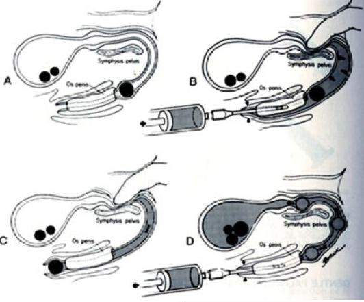 Ureteral Obstruction