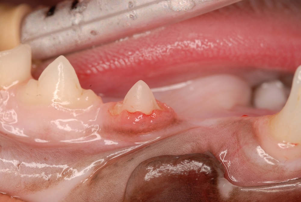 tooth resorption