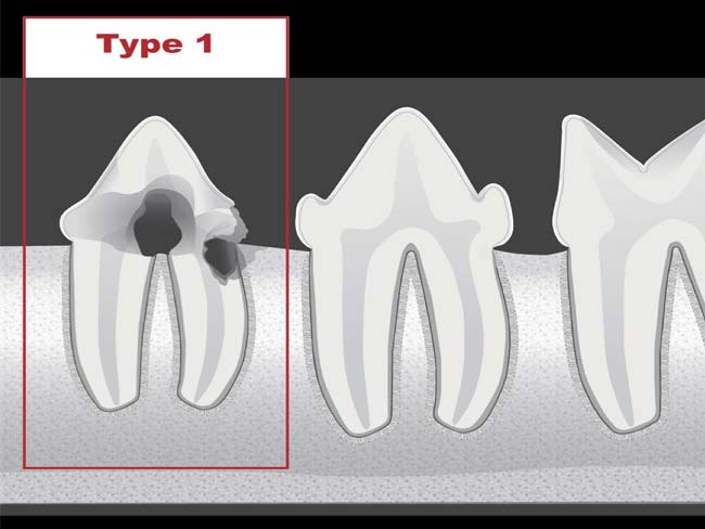 tooth resorption type 1