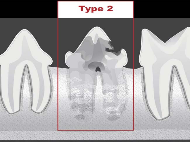 tooth resorption type 2